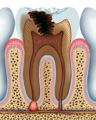 Coquitlam Root Canal, Coquitlam Endodontics Treatment