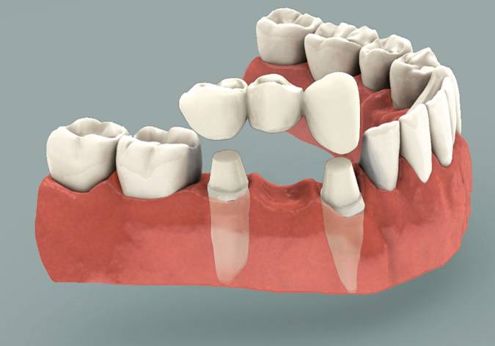 Dental Crowns Coquitlam, Coquitlam Dental Bridge Coquitlam