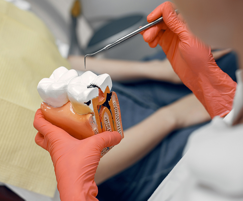 Root Canal Treatment Coquitlam
