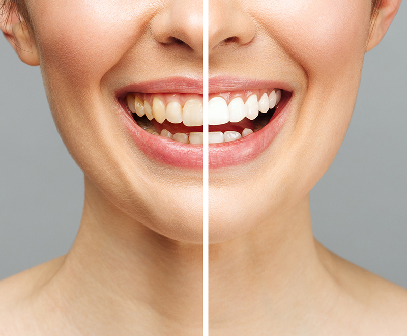 Teeth Whitening Coquitlam
